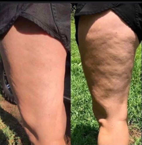 SmoothRise™ Anti-cellulite Massage Oil