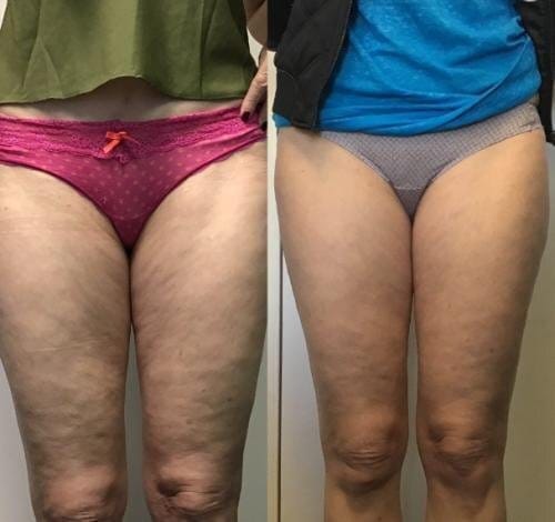 SmoothRise™ Anti-cellulite Massage Oil