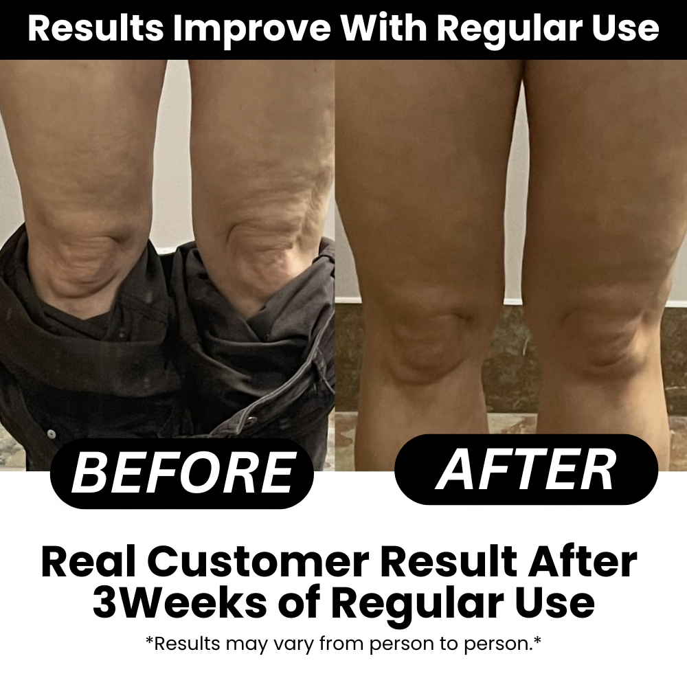 SmoothRise™ Anti-cellulite Massage Oil