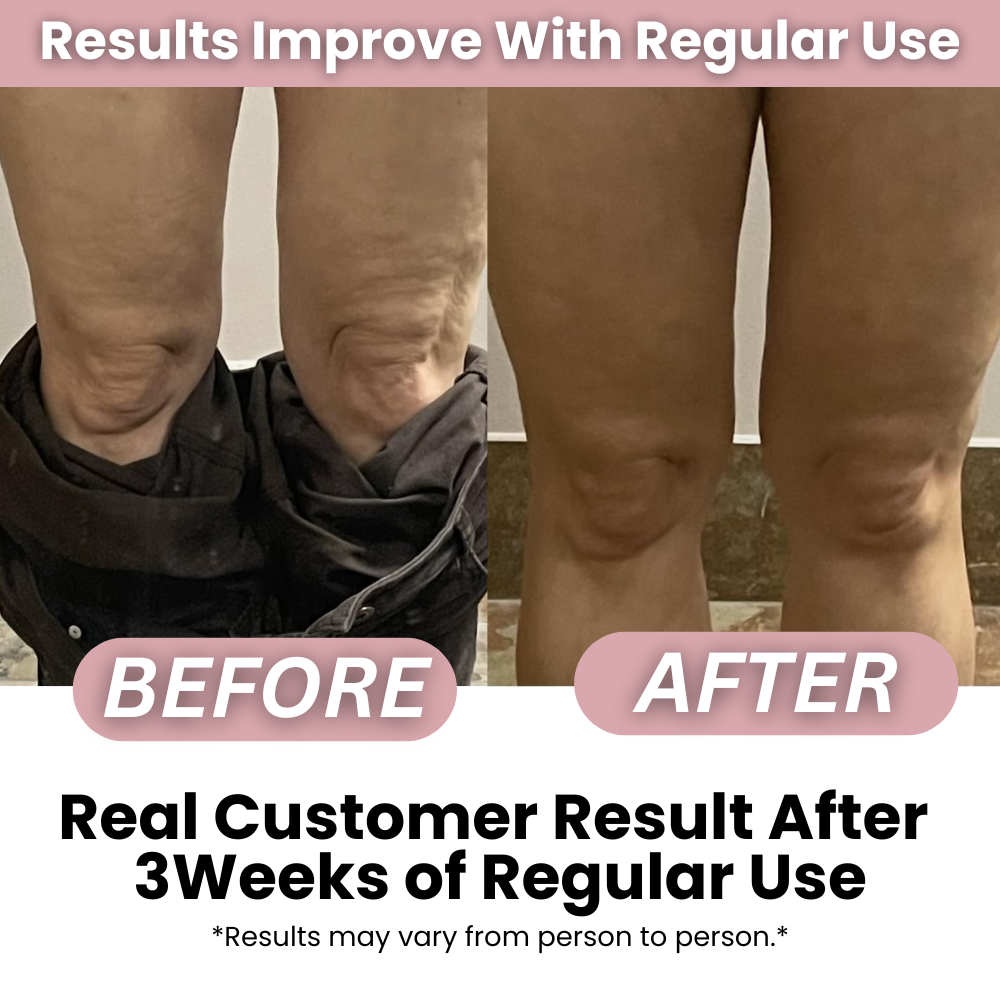 SmoothRise™ Anti-Cellulite Massage Roller