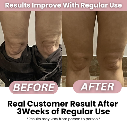 SmoothRise™ Anti-Cellulite Massage Roller